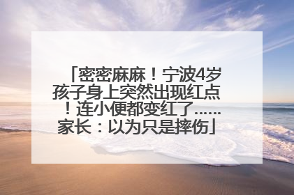 密密麻麻！宁波4岁孩子身上突然出现红点！连小便都变红了……家长：以为只是摔伤